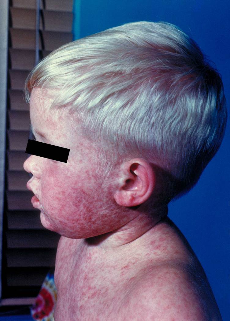 A shirtless child with a dense pattern of red bumps covering their face and chest. 