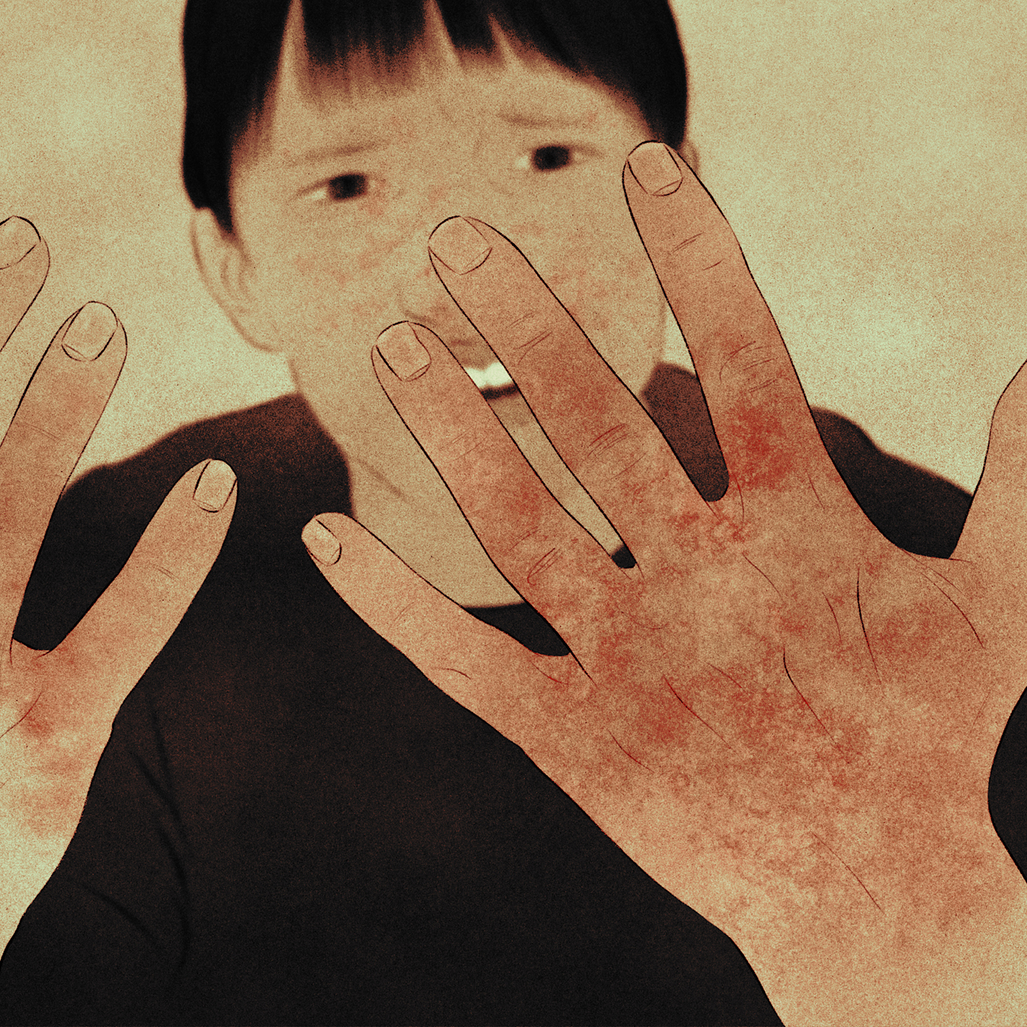 A person looks with an anguished expression at their hands, which are covered in a red rash.