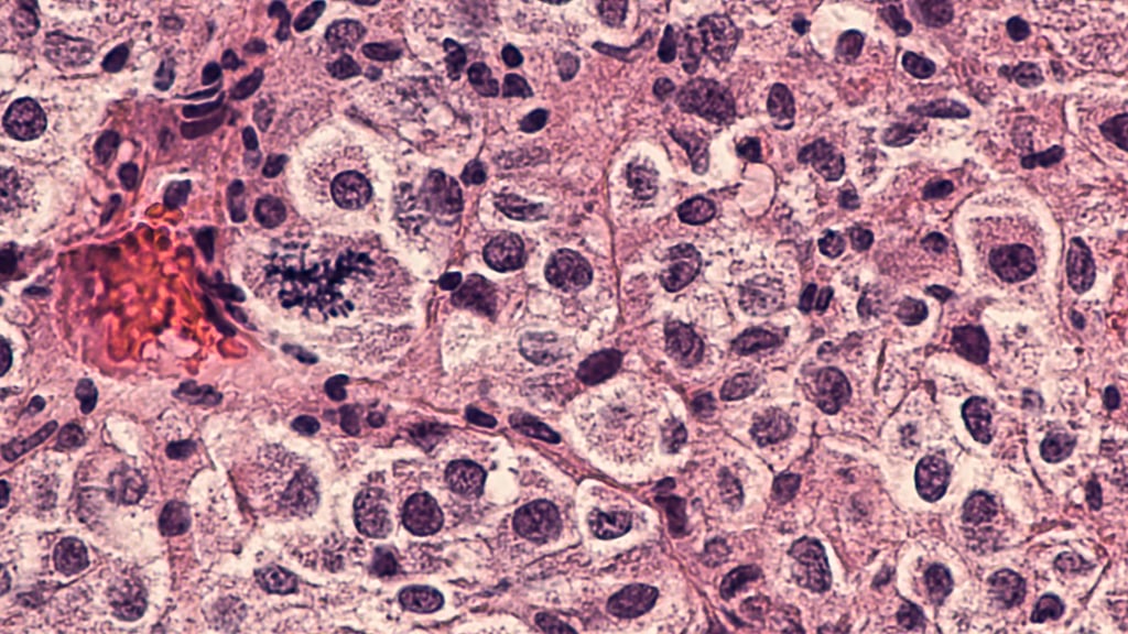 A biopsy shows pigmented cells and mitosis of metastatic melanoma, a type of skin cancer associated with sun exposure. Photo: Shutterstock A biopsy shows pigmented cells and mitosis of metastatic melanoma, a type of skin cancer associated with sun exposure. Photo: Shutterstock